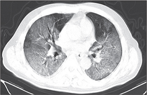 肺炎 ct