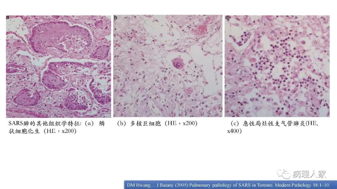 病毒性肺炎切片图片