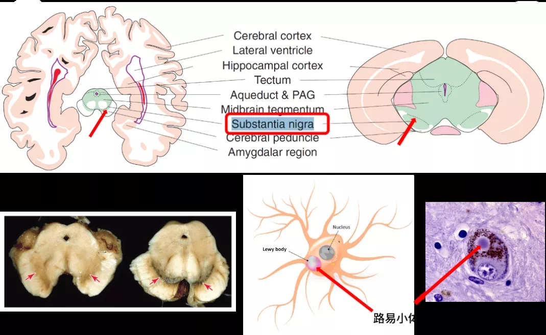帕金森病黑质图片