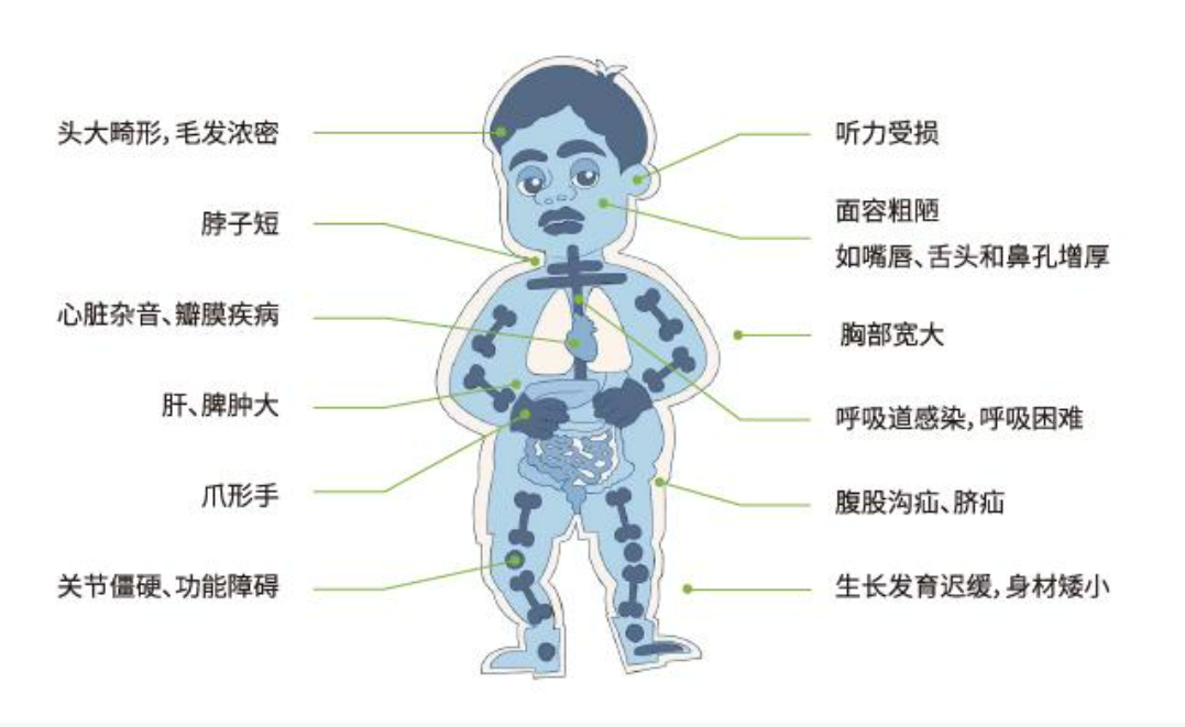 黏多糖贮积症