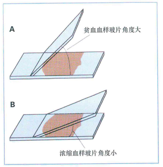 血涂片的制作图片