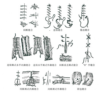 超减张精细缝合的步骤图片