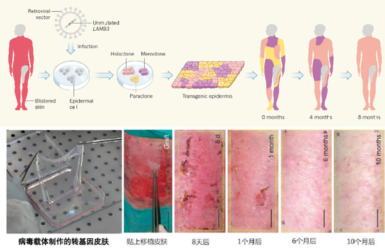 图16。 病毒载体制作转基因皮肤治疗交界型大疱性表皮松解症[3]